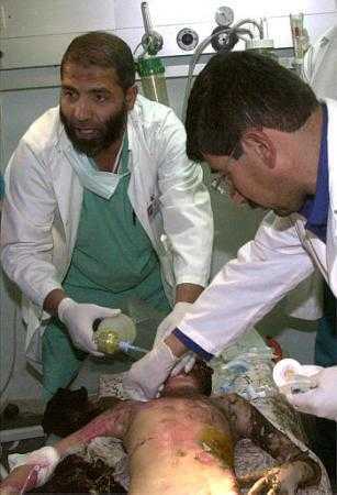 Médicos atendiendo a un niño de 8 años gravemente quemado en un  bombardeo israel�