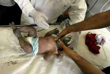 Bebé recibiendo tratamiento tras ser quemado en un ataque aéreo  israel�